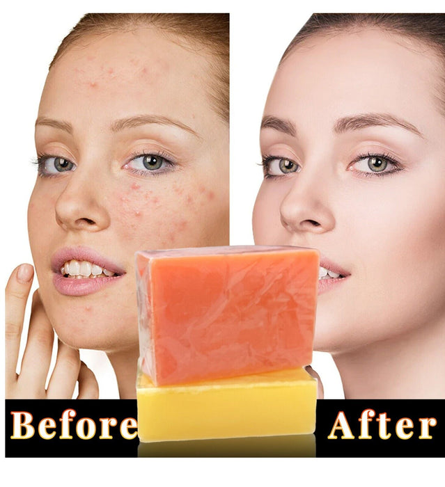 Kojic Acid Soap - Anti Aging Acne Dark Spot